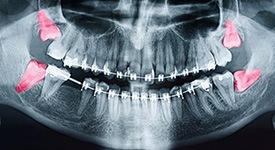 An X-ray of wisdom teeth