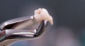 A wisdom tooth in forceps