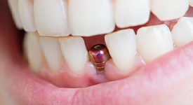 Close-up of a single dental implant in San Antonio, TX during osseointegration