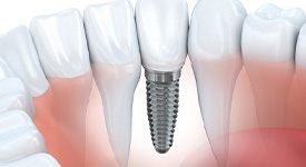 Render of a dental implant in San Antonio, TX after being restored with a crown