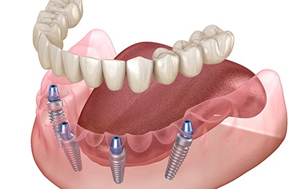 Illustration of dental implants for All-on-4 in San Antonio, TX