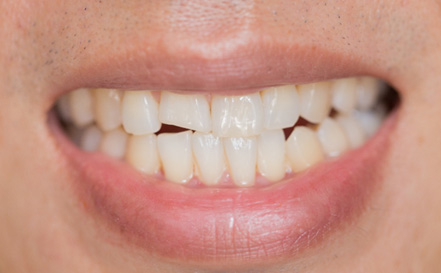 Up-close view of a broken tooth