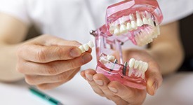 A model of an implant bridge secured to dental implant posts 
