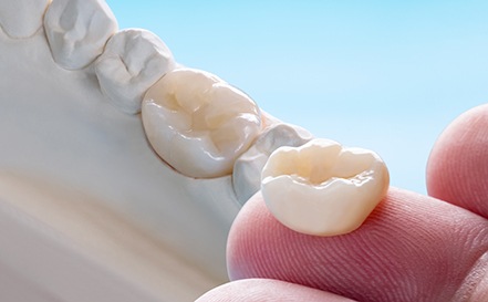 a close-up of a dental crown