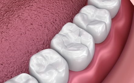 Animated smile with fluoride treatment