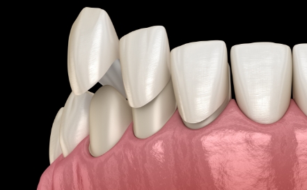 Animated smile during porcelain veneer placement