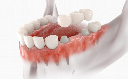 dental bridge anchored with dental crowns