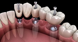 Illustration of dental implant bridge