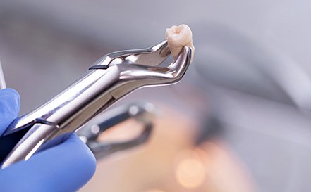 The cost of tooth extractions can vary depending on a variety of factors