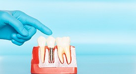 A dentist pointing out the benefits of dental implants in San Antonio