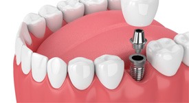 Graphic showing implant post, abutment, and dental crown 