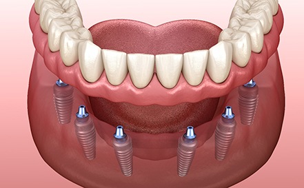Illustration of six dental implant posts for implant dentures in San Antonio, TX