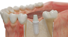 a model of an implant in a jawbone