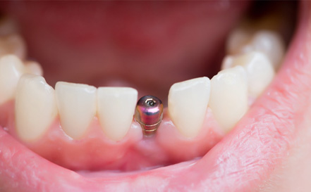 closeup of dental implant in patient’s mouth