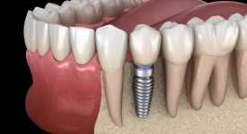 Animated dental implant supported dental crown placement