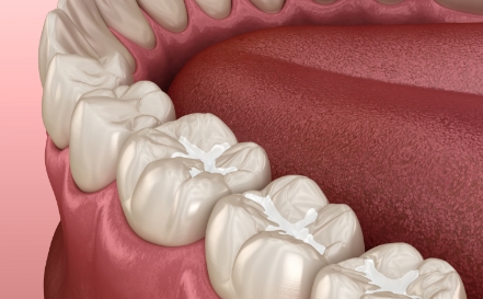 Animated smile with tooth colored fillings