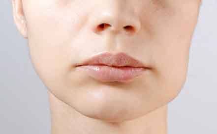 Someone with a swollen cheek