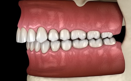 Animated smile in need of equilibration and occlusal adjustment