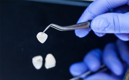 Dentist holding a veneer with tweezers