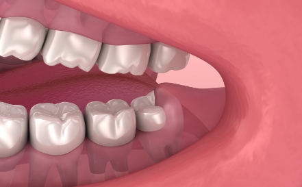 Animated smile with impacted wisdom tooth