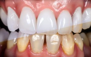 a set of teeth showing before and after its smile makeover
