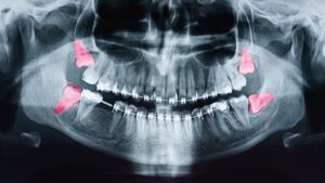 X-ray highlighting wisdom teeth.