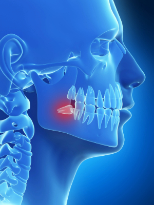 Illustration of wisdom tooth in lower jaw growing sideways